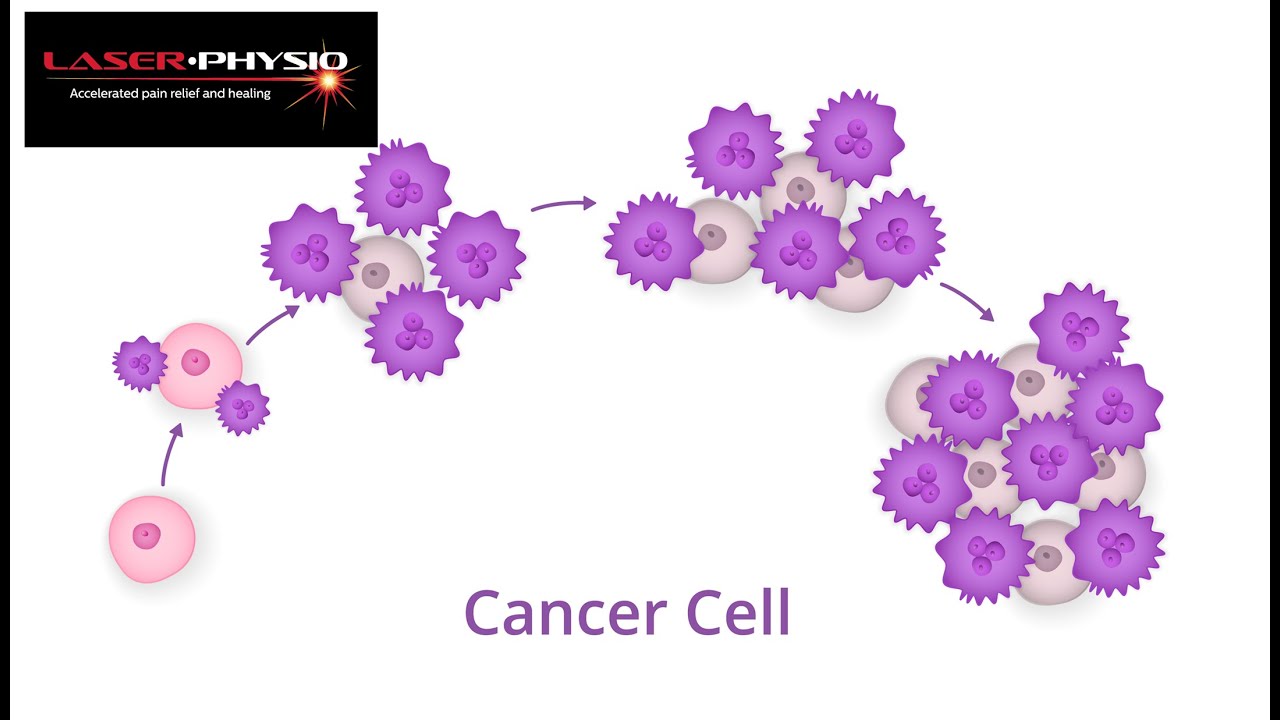 Laser Contraindications Explained 1 Cancer 20230802 111711 1 YouTube
