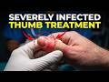 Severely Infected Thumb Treatment