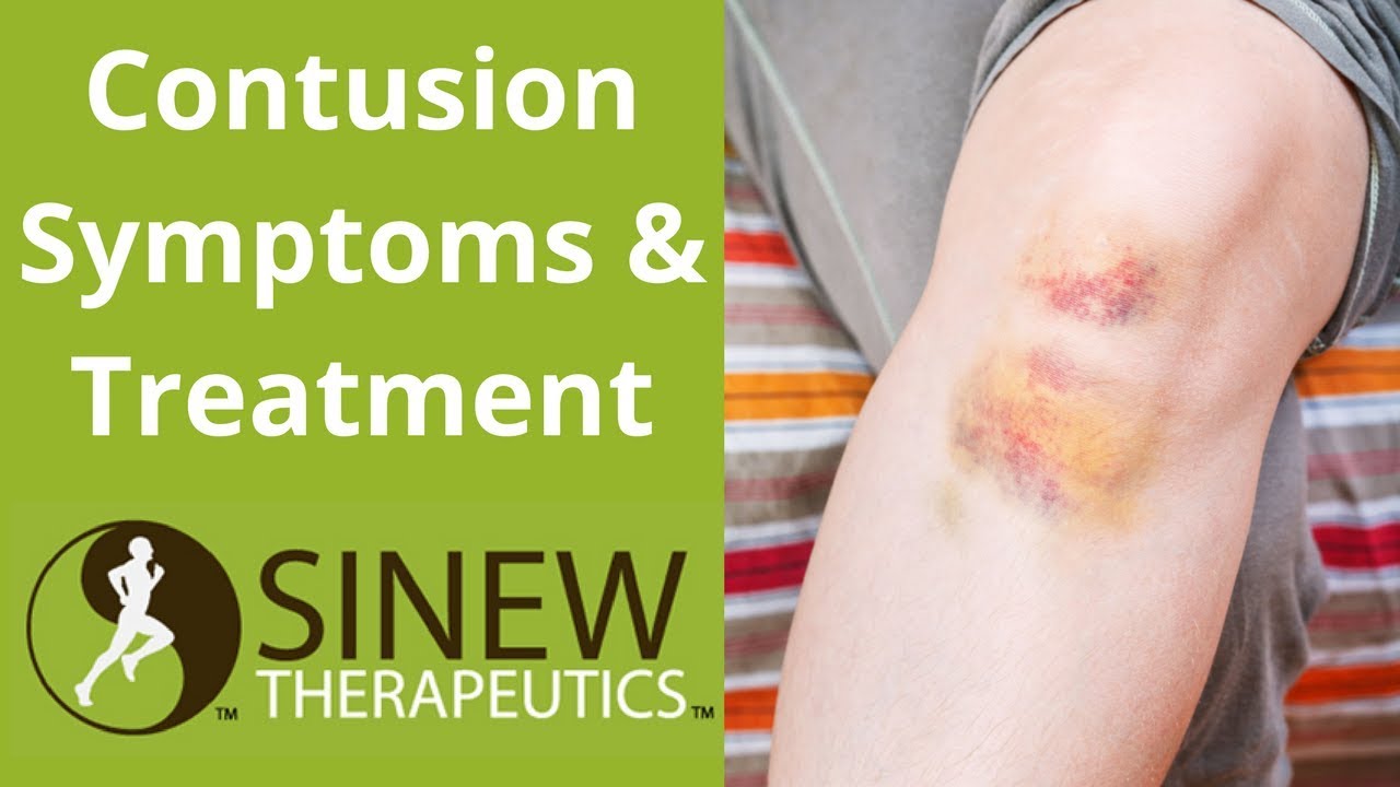 Contusion Symptoms and Treatment YouTube
