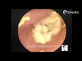 Ear wax removal, Fungus of external auditory canal and review of cholesteatoma of middle ear