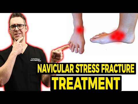 Navicular Stress Fracture Treatment 2021 [Exercise, Shoes & Stretches]
