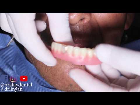 Video: 3 formas de limpiar los dientes de oro