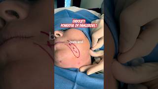 Can Endolift Destroy Fat? Why Technique Determines Your Results