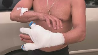 Hialeah Man Describes Terrifying Shark Attack In Biscayne Bay He Could Have Ripped My Arm Off