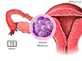 What happens after fertilization human embryo development animation  blastocyst implantation