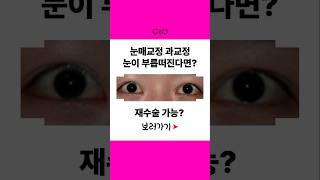 눈매교정 과교정 부작용 , 다시 눈 자연스럽게 뜨고 감을수 있을까?? : 6개월 후 모습 체크✔️ #눈매교정재수술 #눈매교정과교정 #눈매교정부작용 #토안증