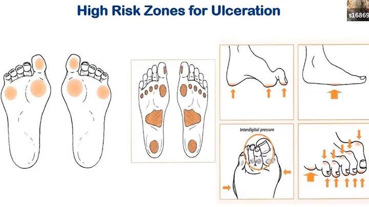 Diabetic Foot Ulcers and Infections - DayDayNews