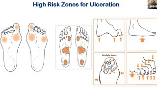 Diabetic Foot Ulcers and Infections screenshot 3