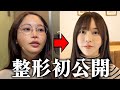 【 韓国整形 】痩せても二重顎になる人はコレ！ ペリカン手術（顎下筋肉縛り）ダウンタイムの公開！ダウンタイムを早める秘訣公開！！！　【旅VLOG】