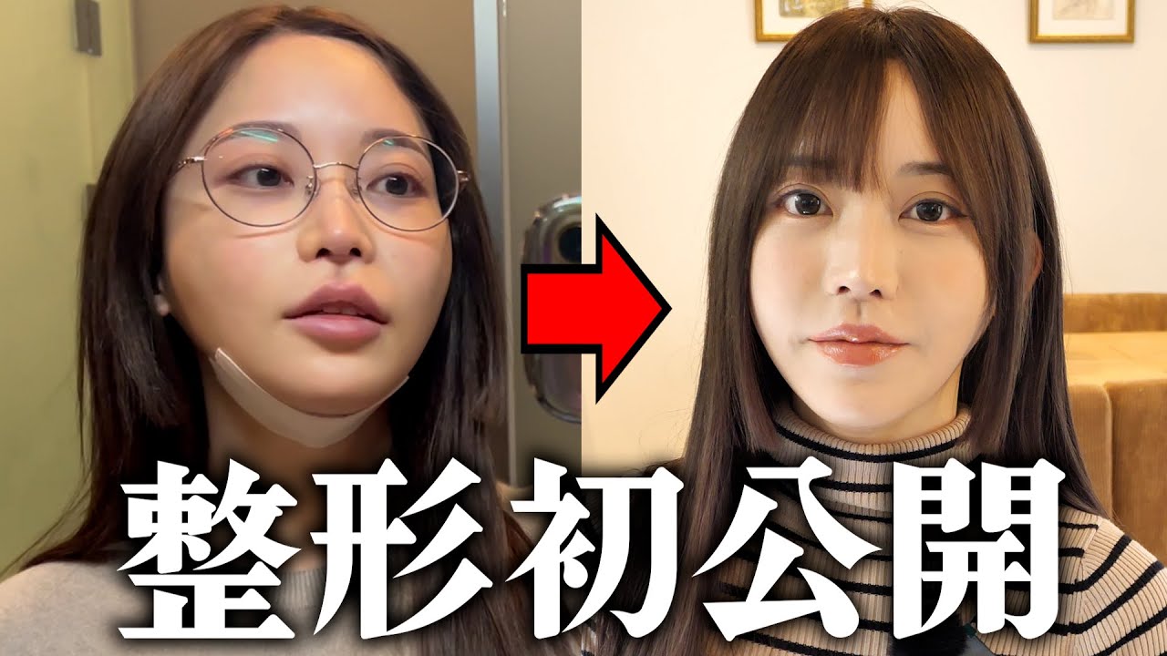 【 韓国整形 】痩せても二重顎になる人はコレ！ ペリカン手術（顎下筋肉縛り）ダウンタイムの公開！ダウンタイムを早める秘訣公開！！！　【旅VLOG】