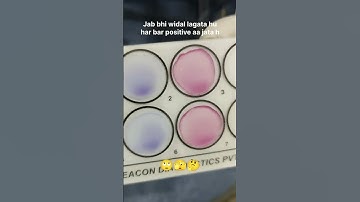 Widal Test: The Controversial Procedure That Changed Medicine Forever