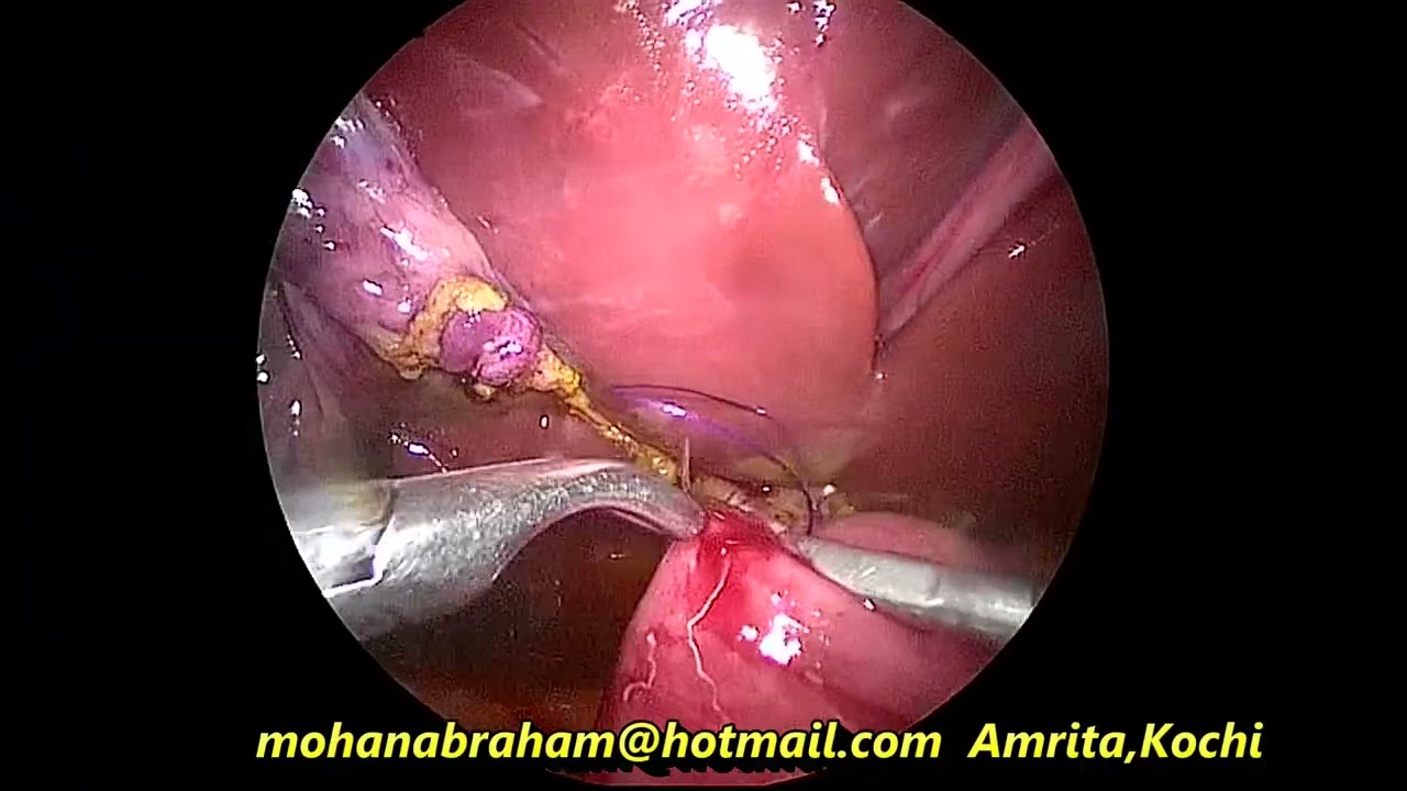 Laparoscopic choledochal cyst excision