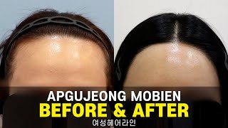 여성헤어라인 3600모 경과영상 I 압구정모비앙의원_경과모음