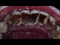 19 yo. Male&#39;s Teeth | Pembersihan Karang Gigi | Scaling | Dentist | Dokter Gigi Tri Putra