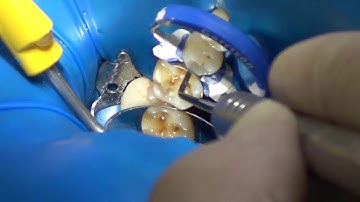 Class II restoration ( full video)