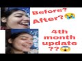 Braces Journey || 4th month update || Before After || Age 22 || Extraction Gap Filled or not?