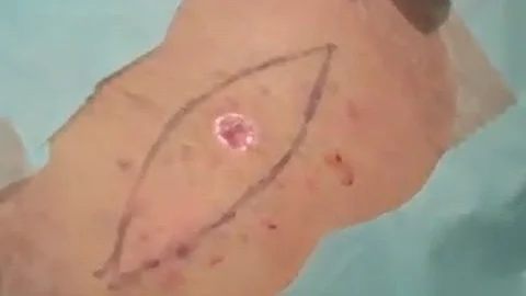 Quais as chances de cura do melanoma?