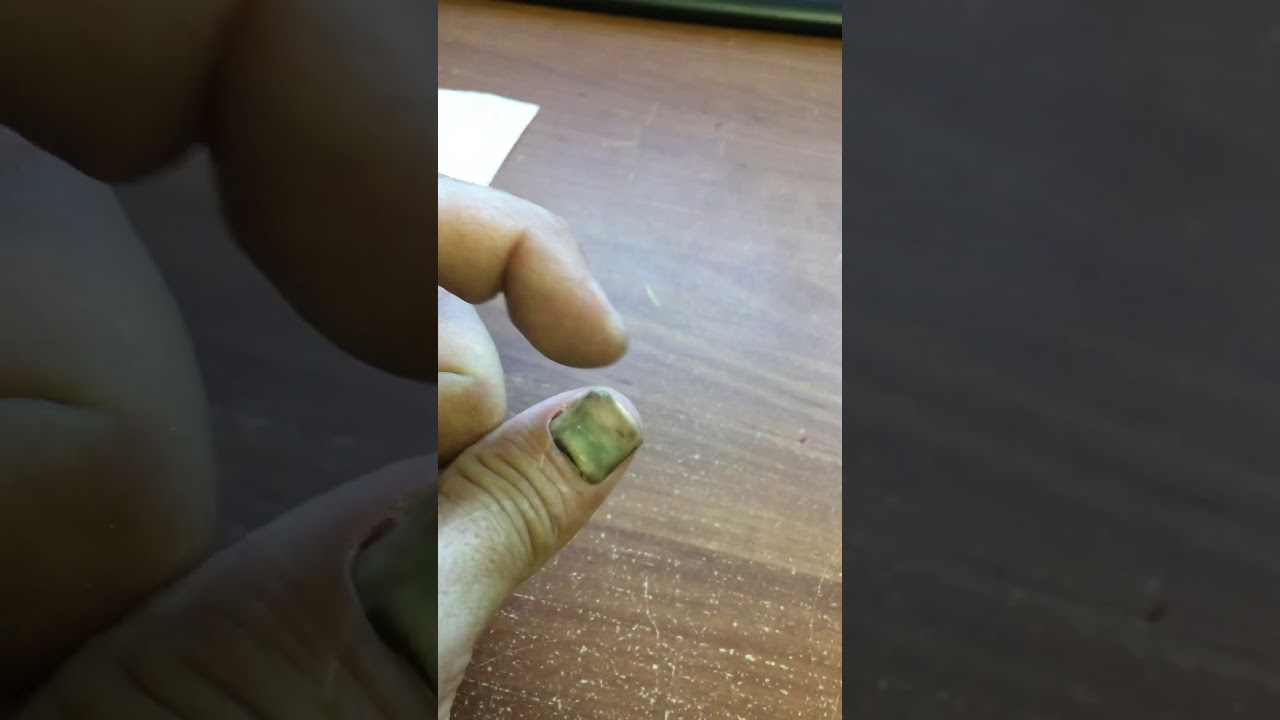 Fingernail falls off YouTube