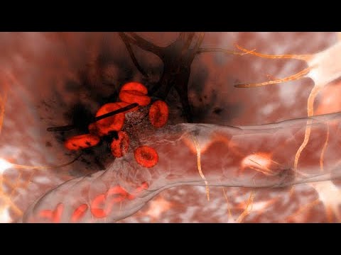 Vídeo: Accidente Cerebrovascular Hemorrágico: Síntomas, Tratamiento Y Perspectivas A Largo Plazo