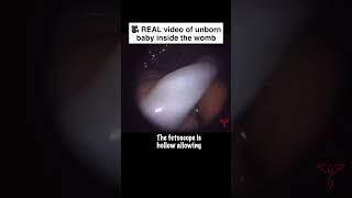 REAL video of unborn baby inside the womb | FETOSCOPY Explained