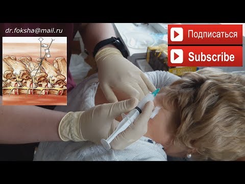 Лечение ОСТЕОХОНДРОЗА | БЛОКАДА | Cervical Injections