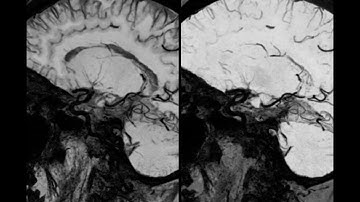 Vessel wall imaging using high resolution 3D CUBE T1 fat sat with MSDE and HyperSense