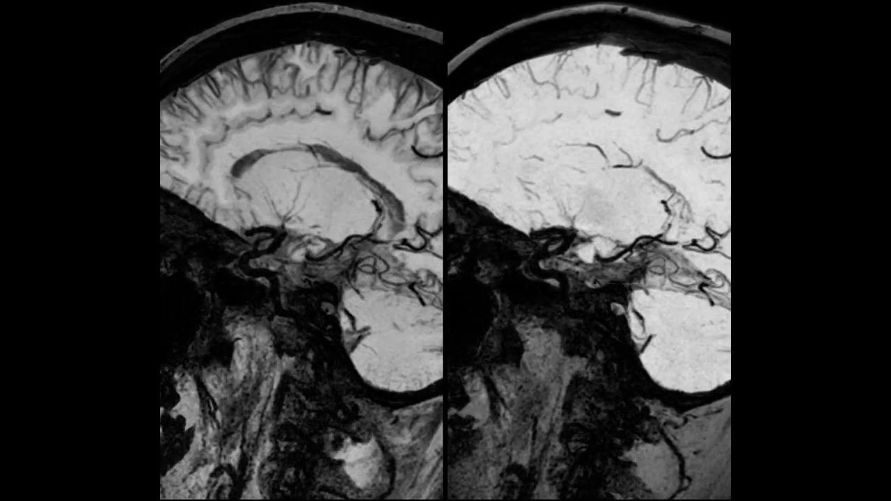 Vessel wall imaging using high resolution 3D CUBE T1 fat sat with MSDE and HyperSense