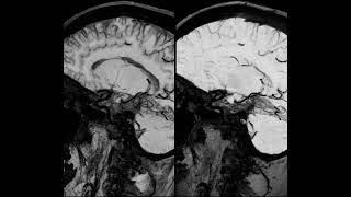 Vessel wall imaging using high resolution 3D CUBE T1 fat sat with MSDE and HyperSense