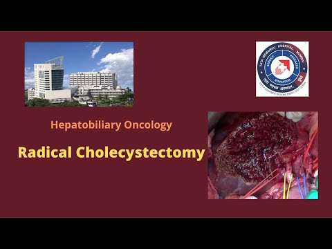 Radical Cholecystectomy