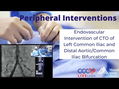 Endovascular Interv. of CTO of L Common Iliac & Distal Aortic/Common Iliac Bifurcation- 4/16/14 Case