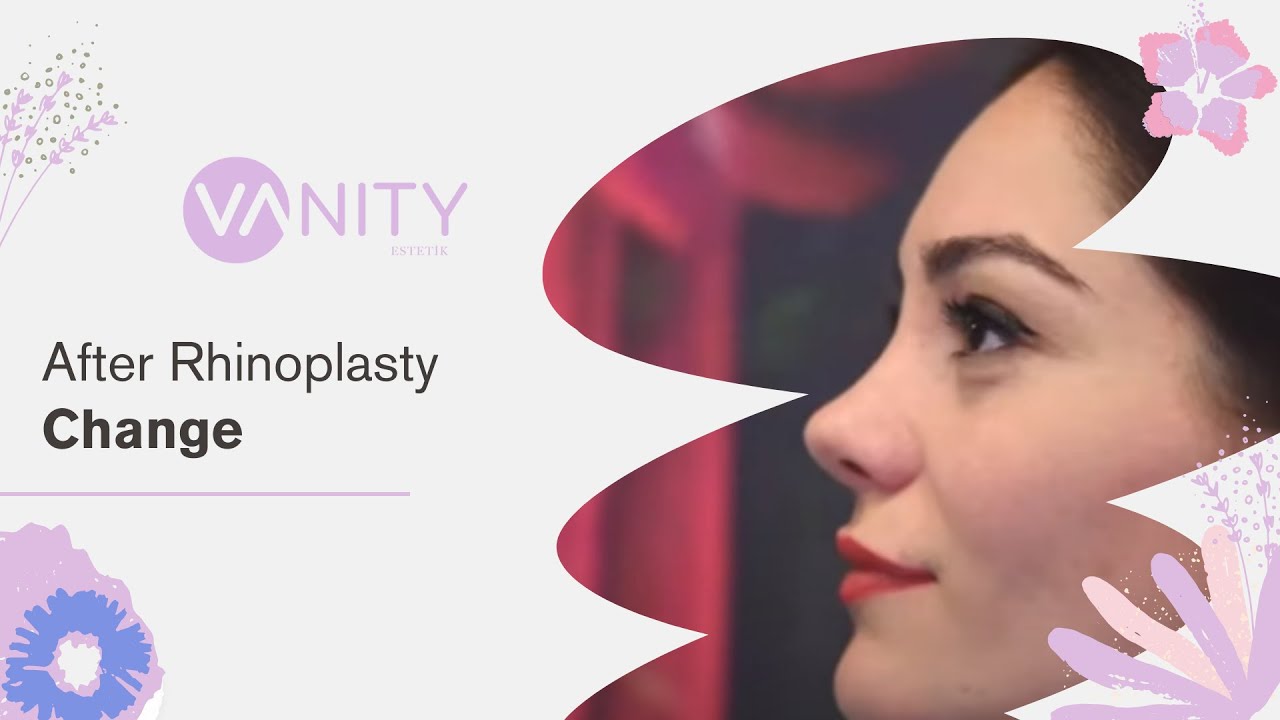 After Rhinoplasty Change Vanity Aesthetics closedrhinoplasty 