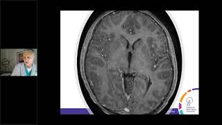 Medulloblastoma - Malignant Brain Tumor in Children & Adults