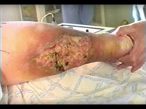 Хирургическое лечение трофических язв вследствие хронической венозной недостаточности, 2002