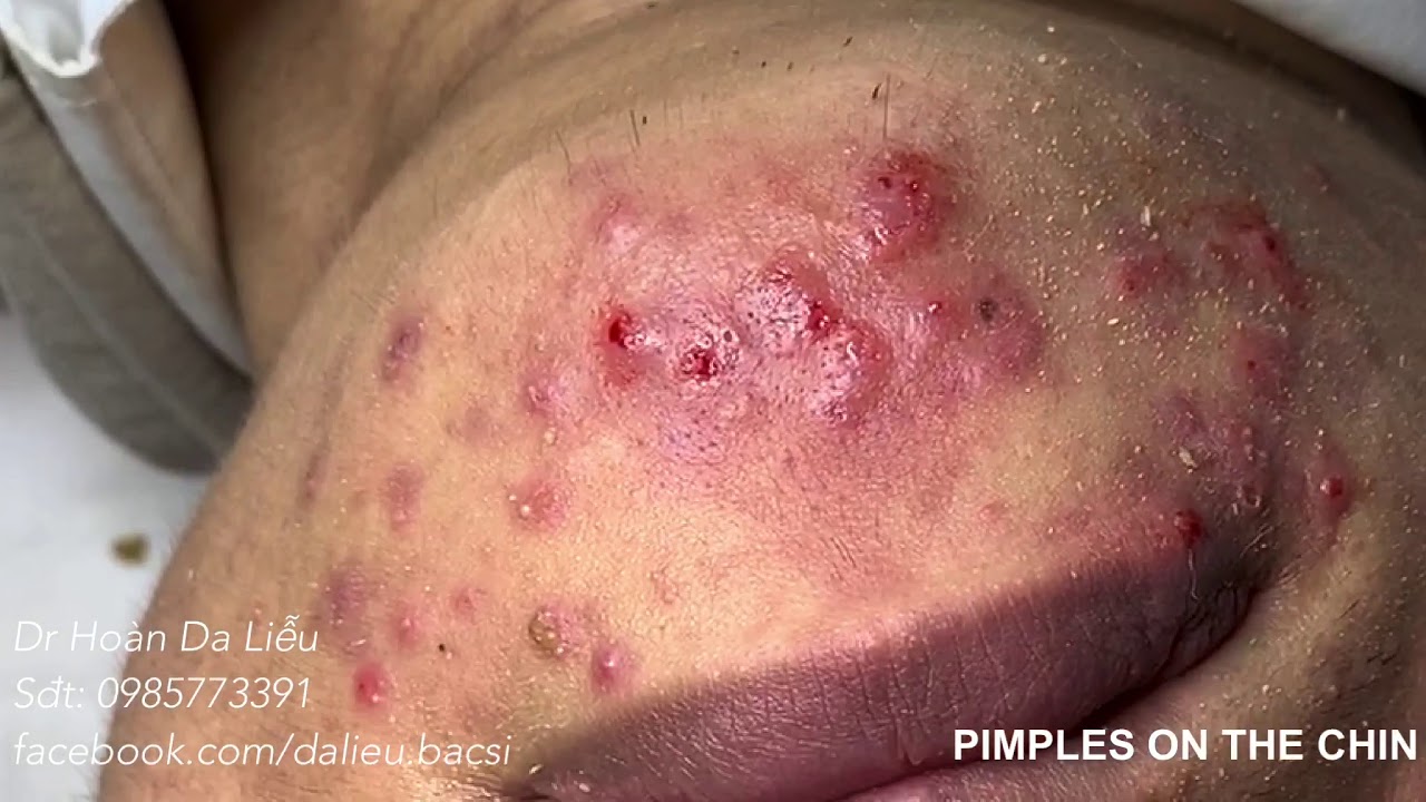 Dermatologist treating squeeze pimples, whitehead blackhead, pustule, anti acnes|Pimples on the chin
