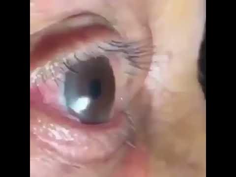 Como quitar lo morado del ojo