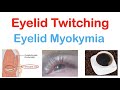 Eyelid Twitching Eyelid Myokymia Triggers Pathophysiology Symptoms Diagnosis Treatment Eyelid Twitching Eyelid Myokymia Triggers Pathophysiology Symptoms Diagnosis Treatment