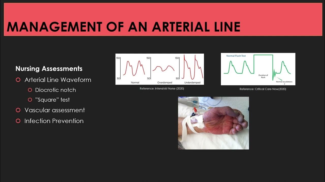 Hemodynamic Monitoring Device & Line Management YouTube