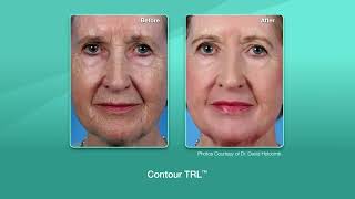 Sciton Contourtrl Deep Resurfacing Laser