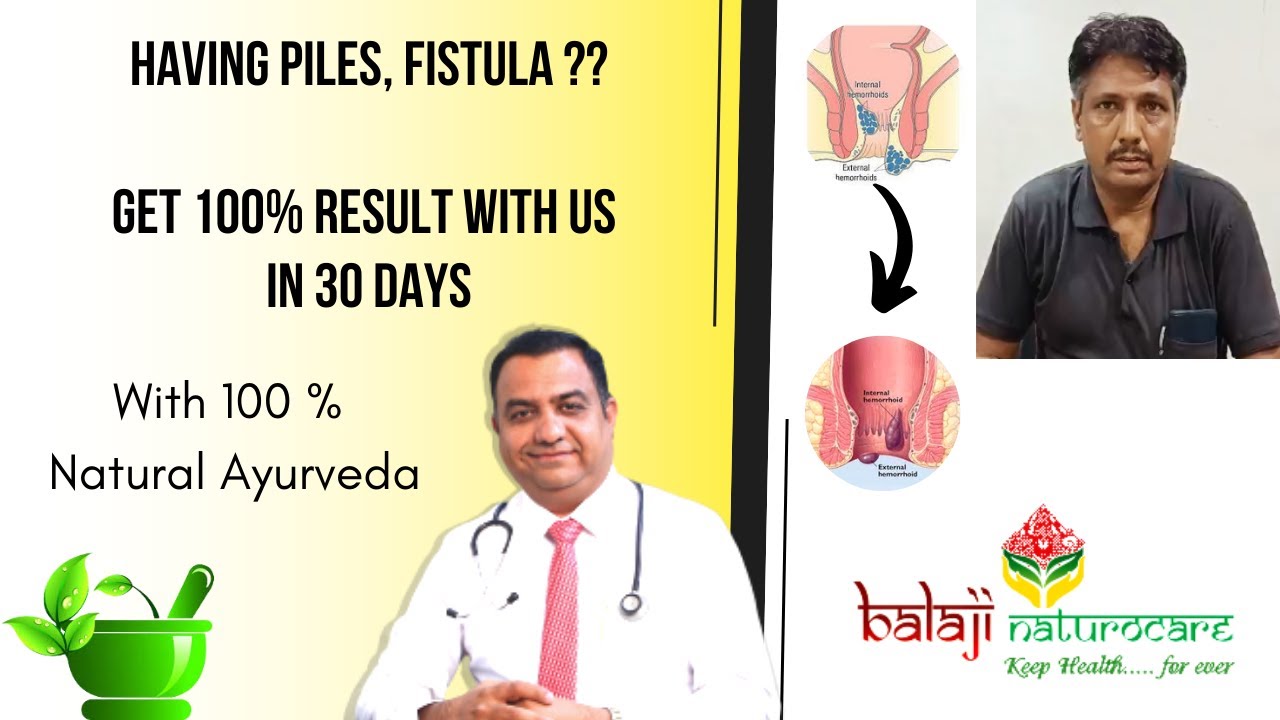 PILES, FISTULA TREATMENT WITH BALAJI NATUROCARE [ BEFORE & AFTER TREATMENT]