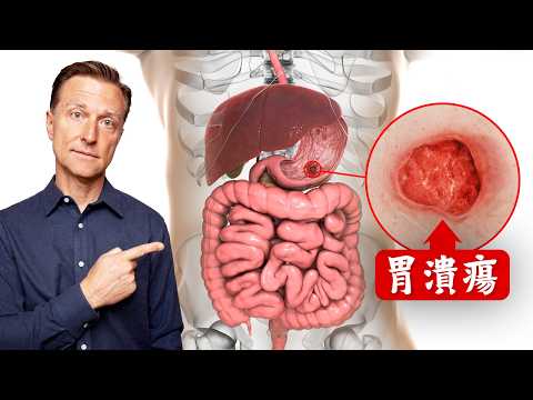 腸胃潰瘍最快自然療法,柏格醫生 Dr Berg