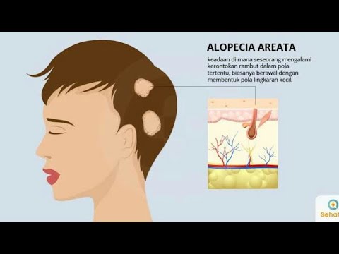 Video: Ketika Alopecia Psikogenik Adalah Diagnosis Yang Salah