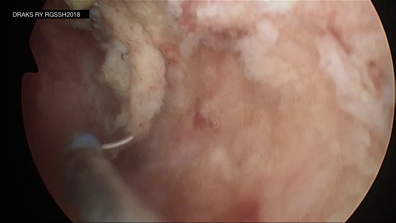 TURBT of Large Bladder Tumor