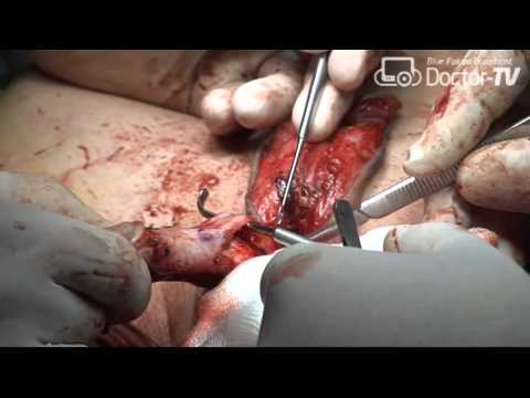 Video: Genitální Plastická Chirurgie: Proč To ženy Dělají