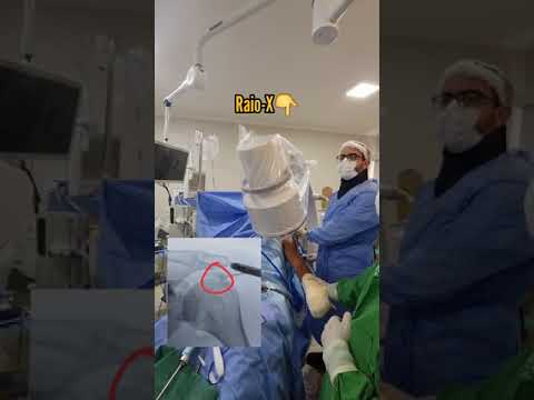 Vídeo: A tendinose do supraespinal requer cirurgia?