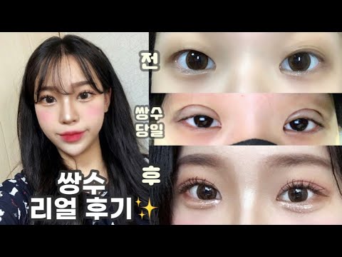 [쌍수 vlog ] 쌍수 브이로그 | 리얼쌍수후기 | 쌍수당일~쌍수3개월차까지 쌍수과정! | 비포에프터 - YouTube
