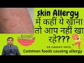 Skin allergy में ये खाना तो बिलकुल नहीं खाना हे। Foods to be avoided in urticaria | Dr Gaurav Patel