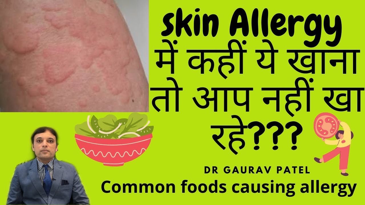 Skin allergy में ये खाना तो बिलकुल नहीं खाना हे। Foods to be avoided in urticaria | Dr Gaurav Patel