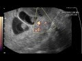 ЭКСКЛЮЗИВ УЗИ ПОСЛЕ гистероскопии Гетеротопическая беременность в рубце после кесарева сечени