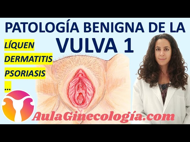 PATOLOGÍA BENIGNA DE LA VULVA: LÍQUEN, DERMATITIS, PSORIASIS, FIBROMAS  -Ginecología y Obstetricia 