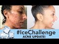 My AMAZING Acne Skincare Update/ Routine! #IceChallenge | BiancaReneeToday